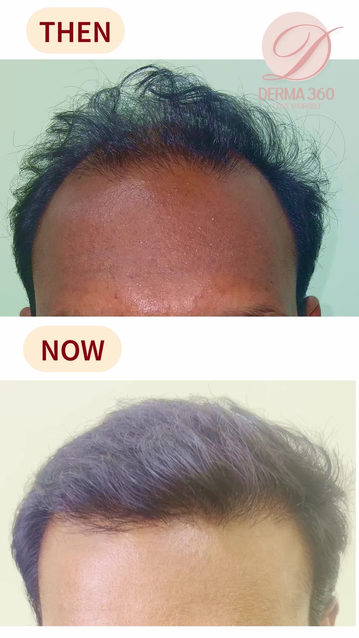 Hair transplant patient journey at Derma 360 Madhapur